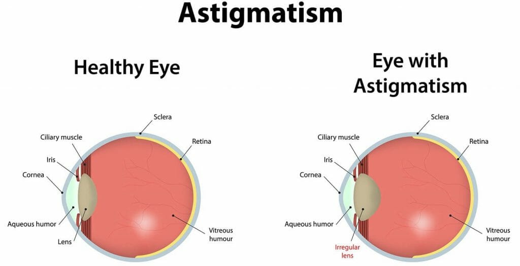 Every thing about Astigmatism and its correction lenses | Lenspk